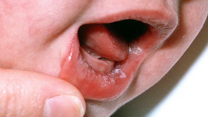 Oral Thrush