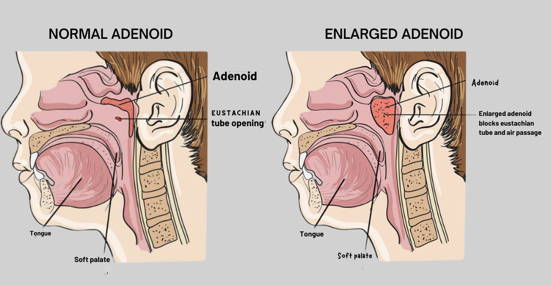 Adenoidal Enlargement Symptoms