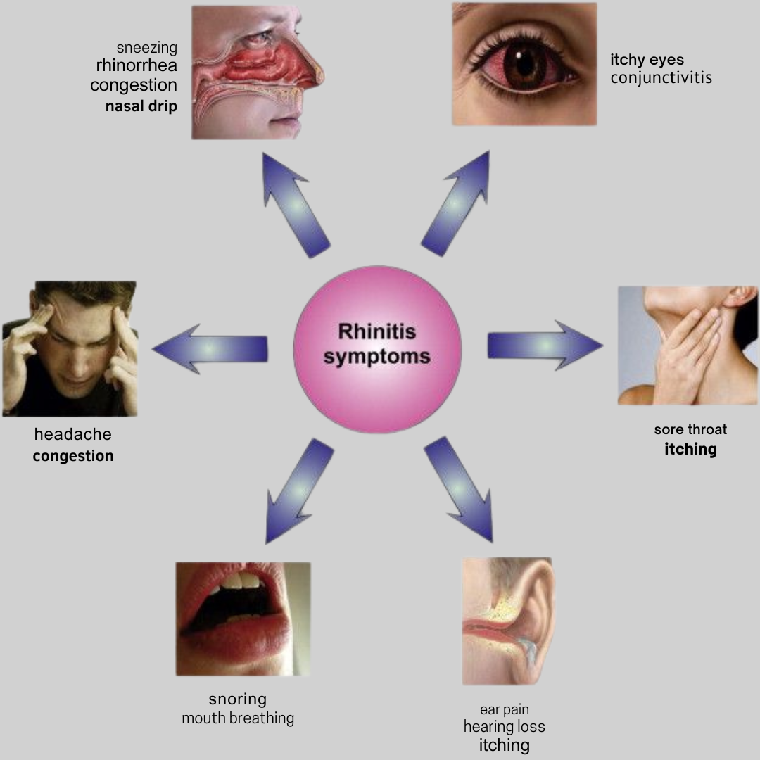 Allergic Rhinitis Symptoms